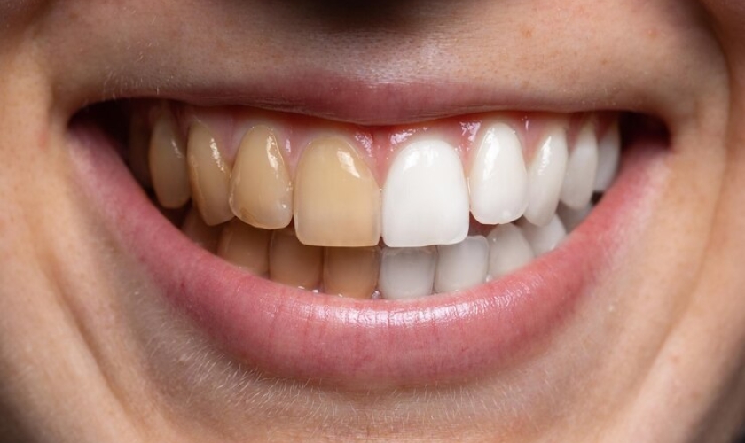 Types Of Tooth Stains And How To Remove Them