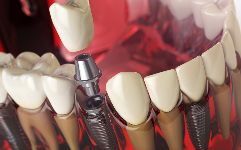 Gum Disease Holding You Back? Know If Dental Implants Are Still An Option