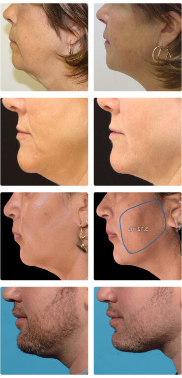 Evoke Patients