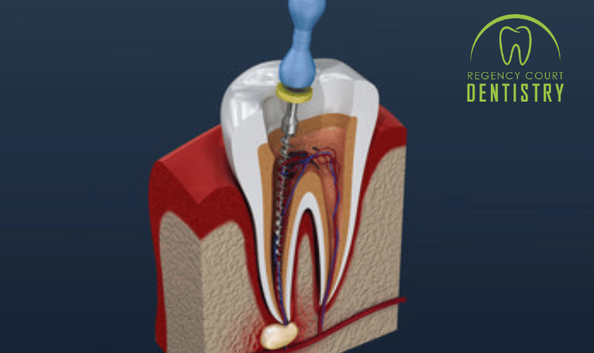 How To Deal With An Infected Root Canal: A Step By Step Guide