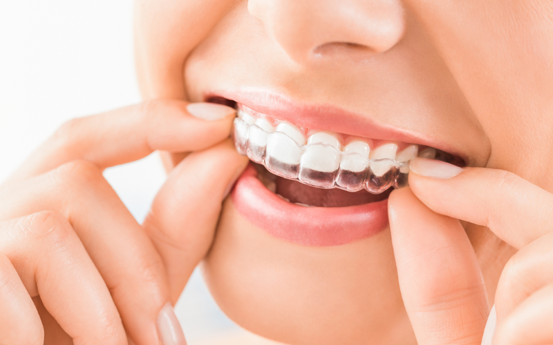 Specific Invisalign Techniques For Addressing Severe Overbites