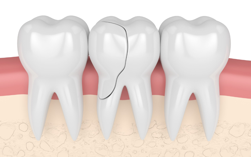 Can Root Canal Fix A Cracked Tooth?