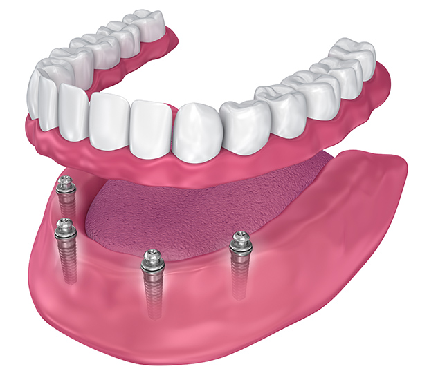 Boca Raton All-on-4 Implants