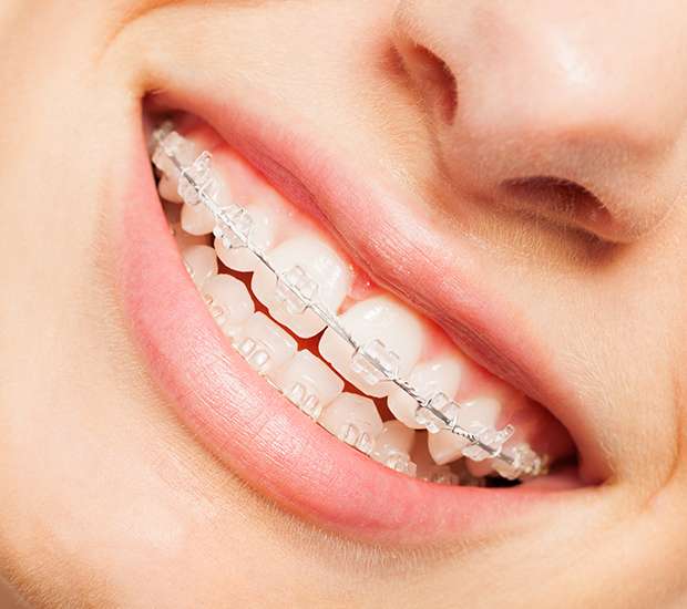 Boca Raton Clear Braces