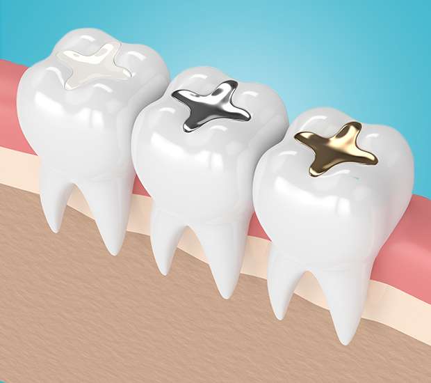 Boca Raton Composite Fillings
