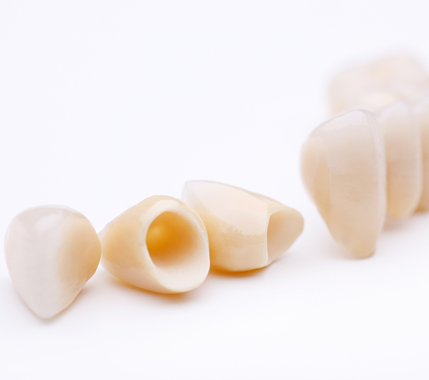 Boca Raton Dental Crowns and Dental Bridges