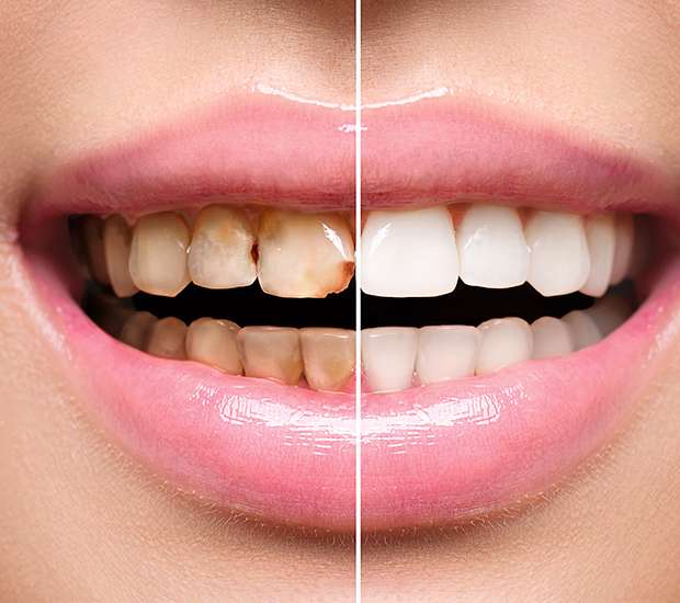 Boca Raton Dental Implant Restoration