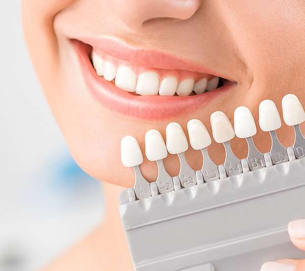 Boca Raton Dental Veneers and Dental Laminates