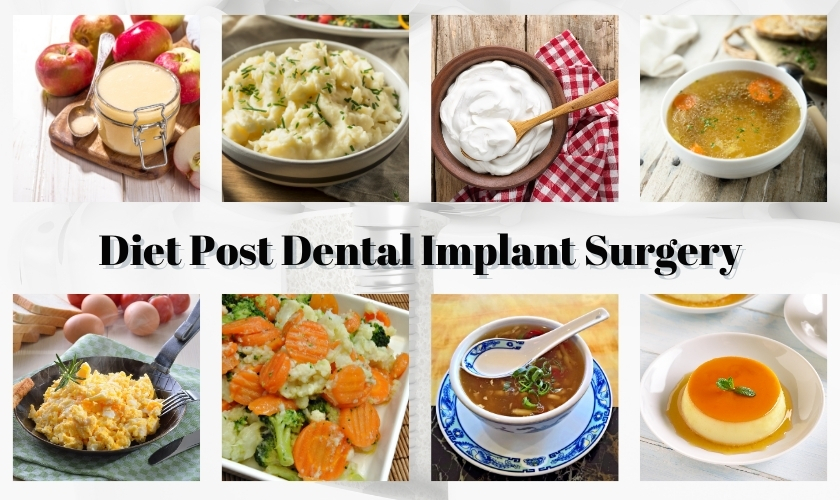 What Can I Eat After Dental Implant Surgery?